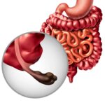 ANS incorpora radioterapia de precisão ao rol obrigatório de planos de saúde a partir de setembro